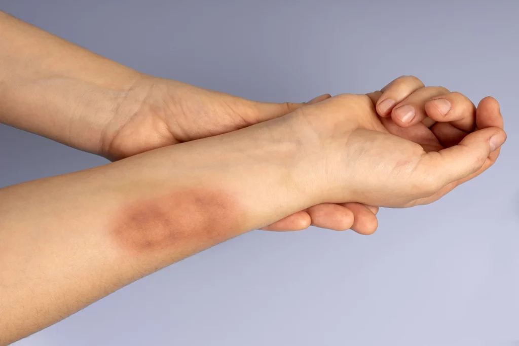 Injury Attorney Ruston LA